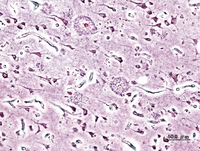 Alzheimer_dementia_(3)_presenile_onset.jpg