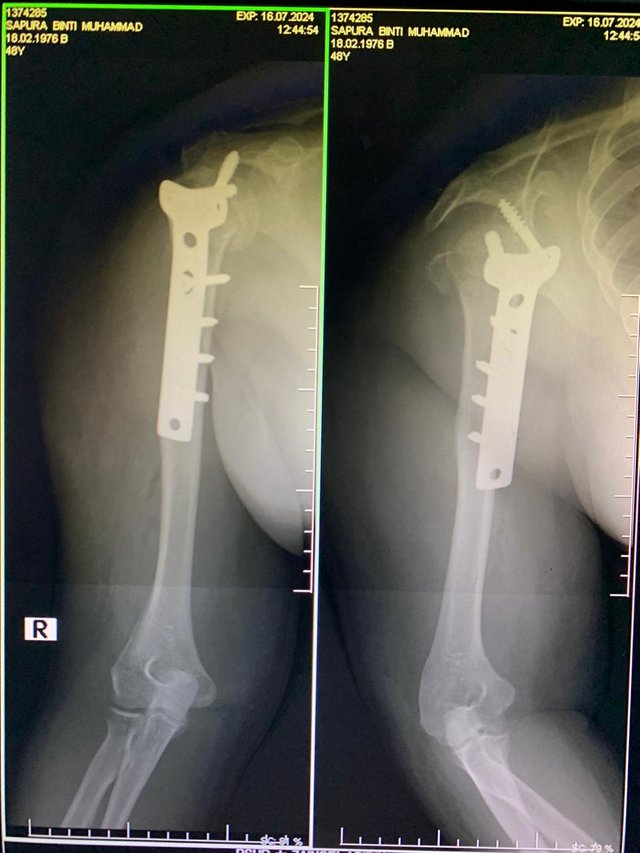 Kak Pura X-Ray.jpeg