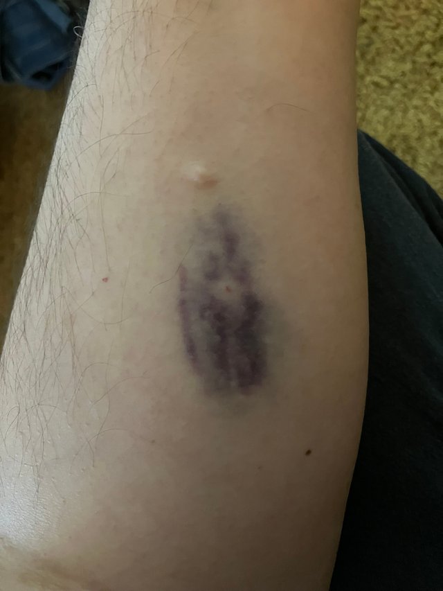 colonoscopy bruise.JPEG