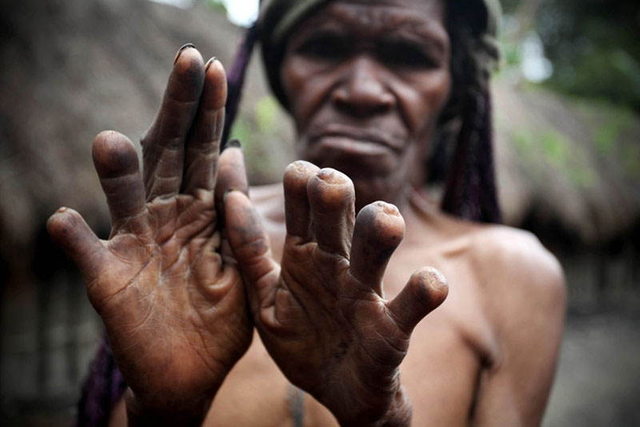 Indonesian Finger Cutting - source: Guardian