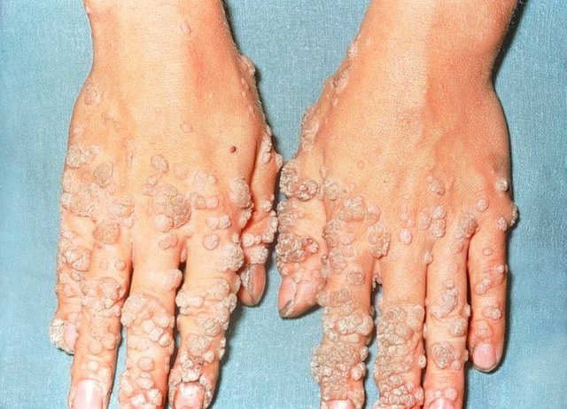 hand wart.jpg