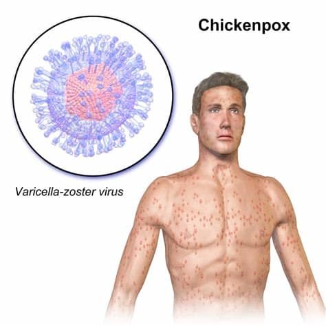 varicella-zoster virus.jpg