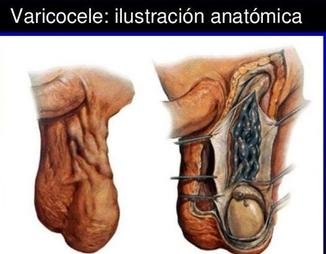 varicocele3.jpg