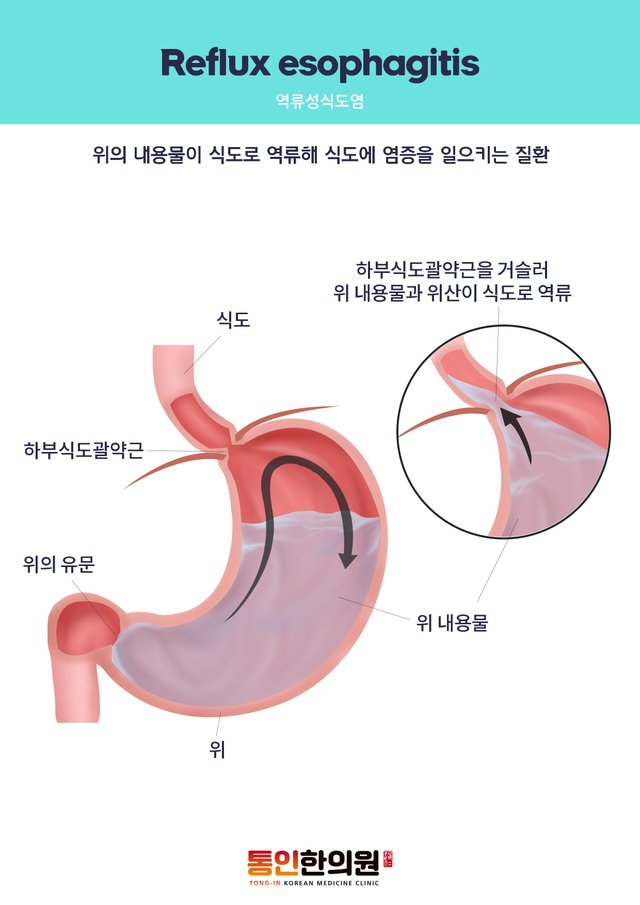 역류성식도염.jpg