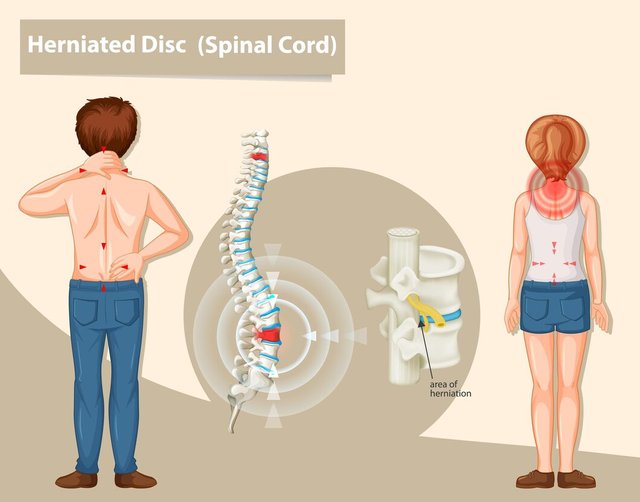 diagram-showing-herniated-disc-human_1308-68862.jpg