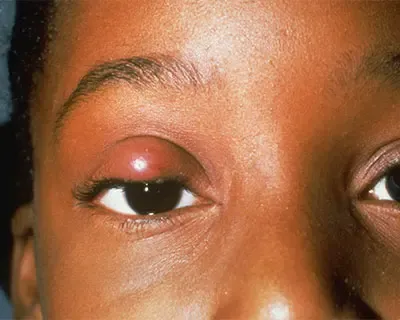 Chalazion_body.webp