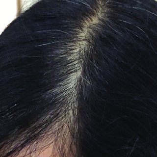 Patients-with-androgenetic-alopecia-seen-here-with-a-widened-part-may-inquire-about-the_Q320.jpg