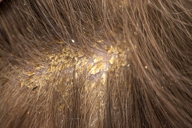 Are_you_worried_about_oily_yellow_dandruff.jpg