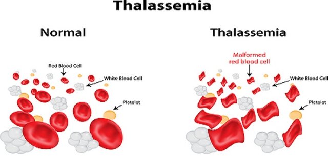 Alpha-thalassemia.jpeg