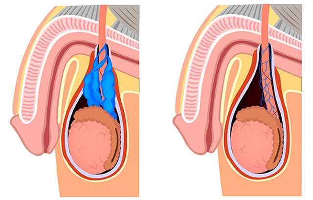 reverse varicocele-min.jpg