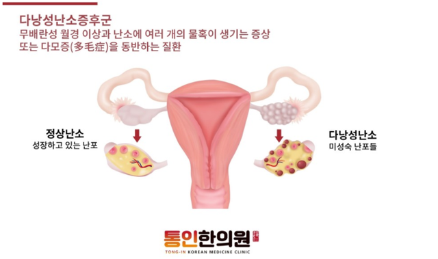 다낭성난소증후군 종각한의원.png