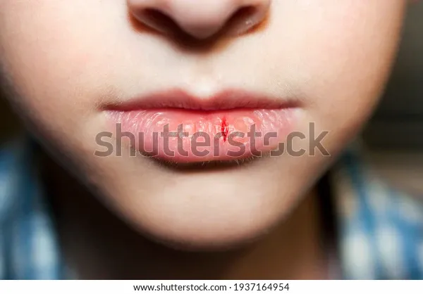 closeup-child-dry-lips-bloody-600w-1937164954.webp