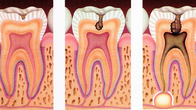 Esquema-caries-dentales (1).png