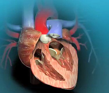 Artificial Heart-Lung Machine Market.jpg