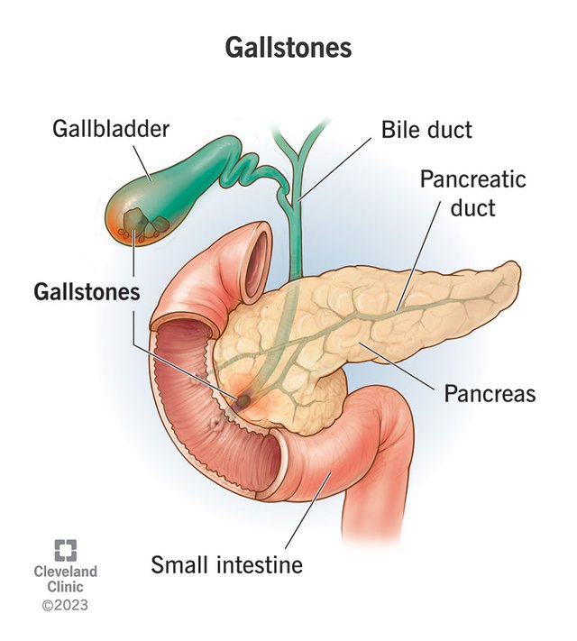 7313-gallstones.jpg