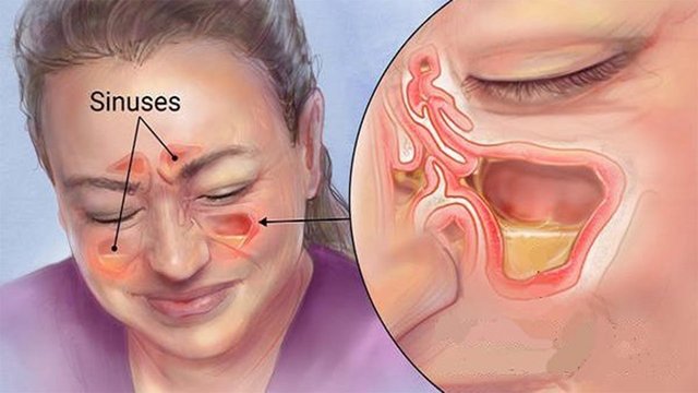 sinusitis3.jpg