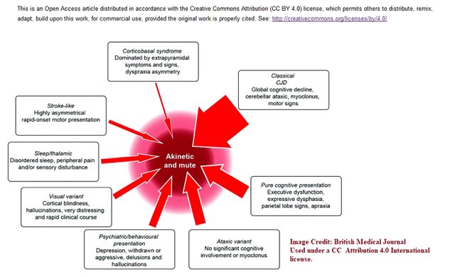 british medical journal cjd disease progression.jpg