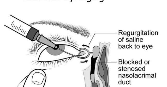 Lacrimal Cannulae1.jpg