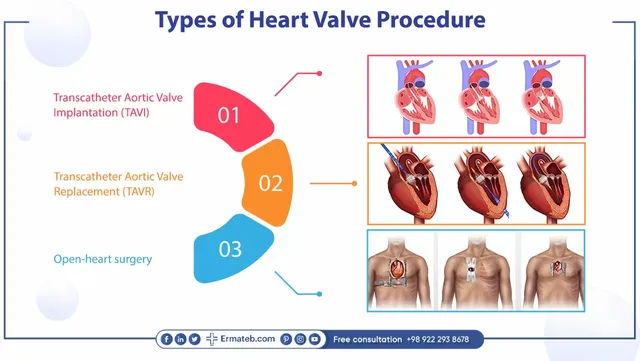 Types-of-Heart-Valve-Procedure.webp