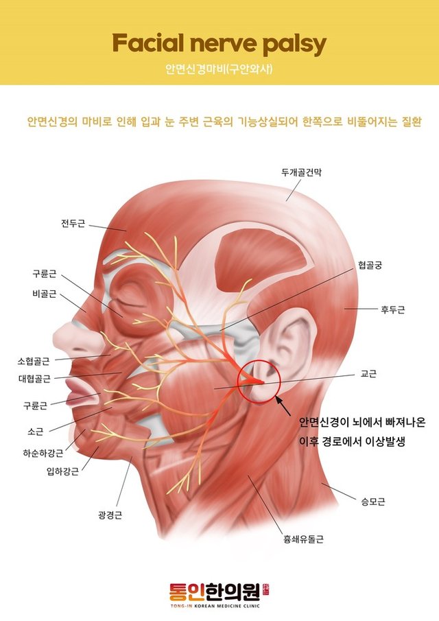 안면신경마비.jpg