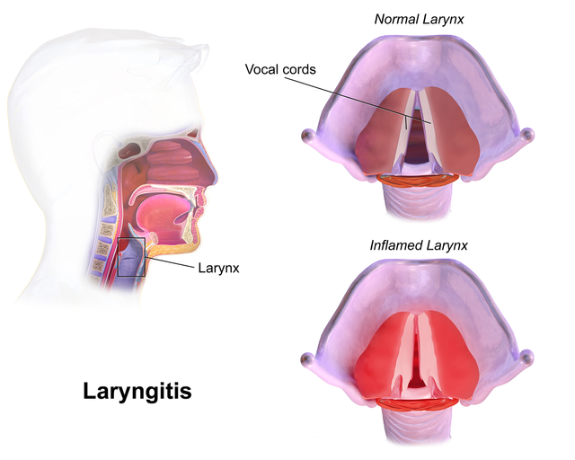 Laryngitis.png