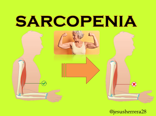 Sarcopenia y Diabetes.png