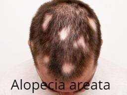 man-with-alopecia-areata (1).jpg