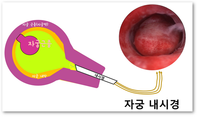 자궁경