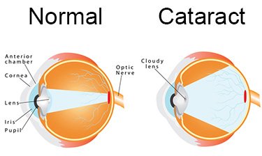normal-cataract-lens-1 (1).jpg