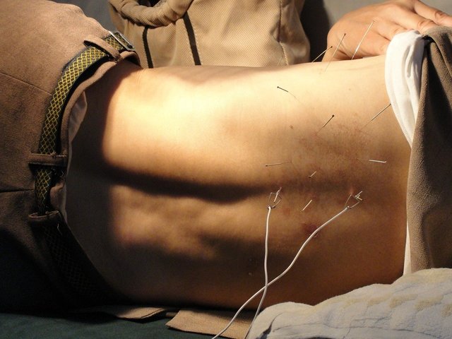 acupuncture-3275458_1280.jpg