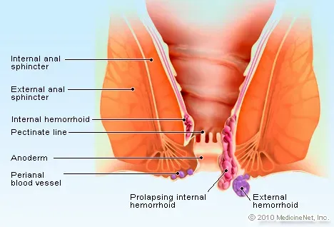 hemorrhoid.webp