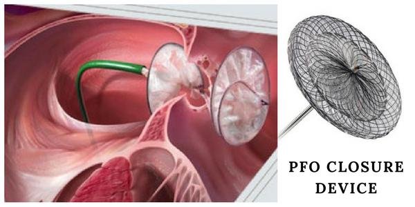 PFO Closure Device.jpg