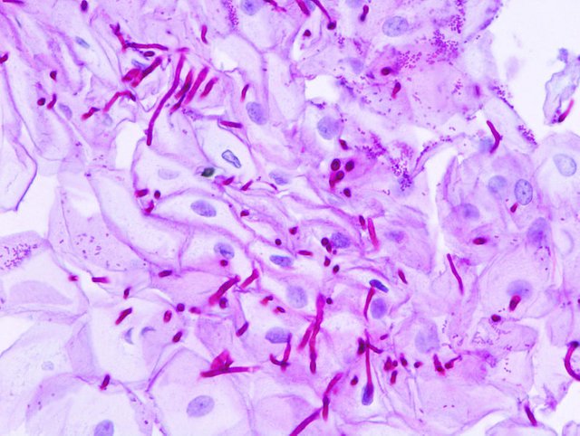 796px-Esophageal_candidiasis_(2)_PAS_stain.jpg