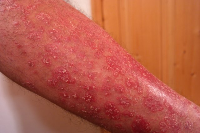 psoriasis-356429.jpg