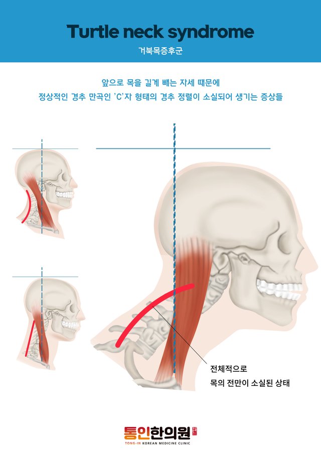 거북목증후군 종각한의원.jpg