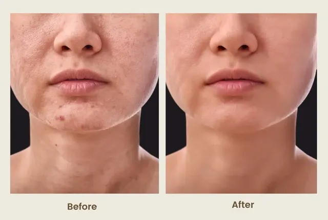 1Exosome-Facial-Rejuvenation-before-and-after-PCH-MedSpa-image-1024x686.webp