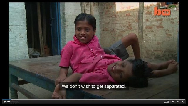 Conjoined-twins-Shivanath-and-Shivram-Sahu-in-India-dont-wish-to-get-separated.jpg