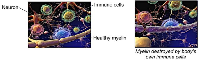 demyelination MS adapted.jpg