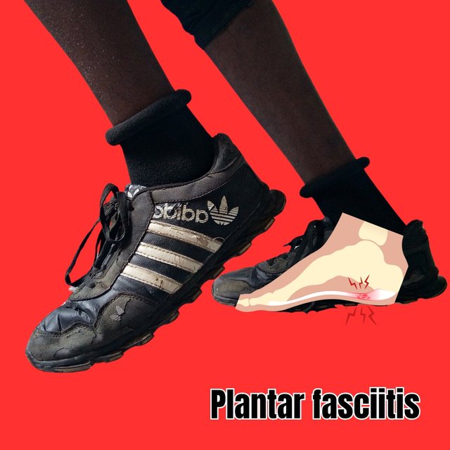 Plantar fasciitis_20241128_191252_0001.jpg