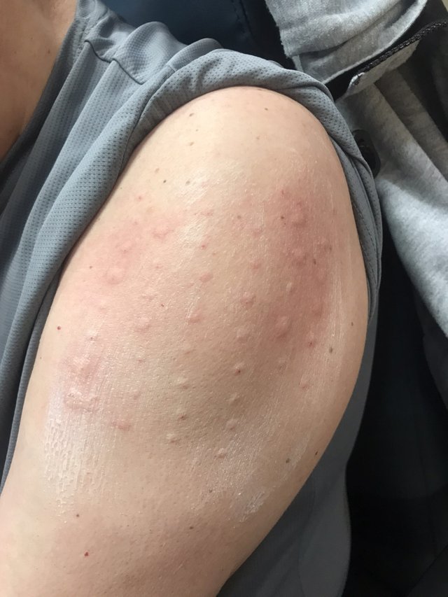 Allergy test1.jpeg