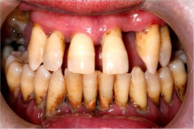 periodontitis.jpg