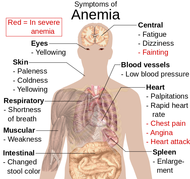 636px-Symptoms_of_anemia.svg.png