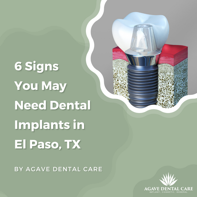 6 Signs You May Need Dental Implants | Implant Dentistry El Paso.png