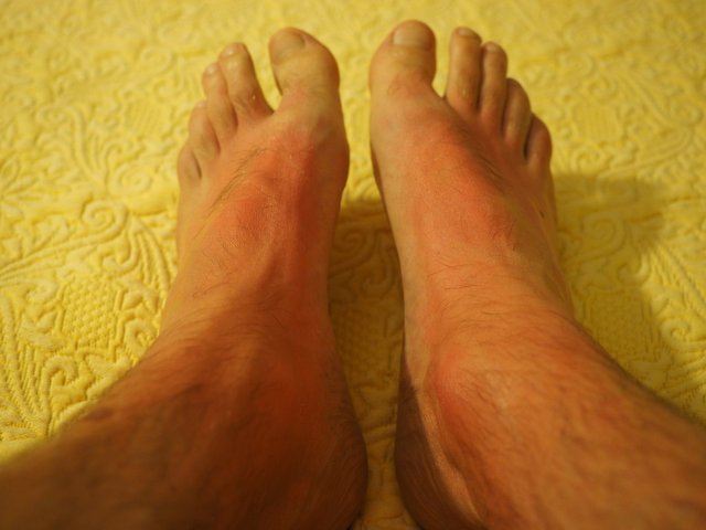 sunburn-1522091_1920.jpg