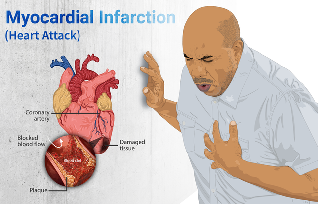 Myocardial infarction (heart attack).png