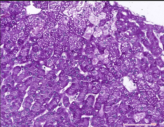 Niemann-Pick Disease And Marburg.png