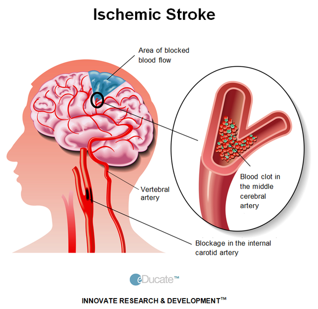 1-lightbox-ischemic stroke-cartid artery-definition.png