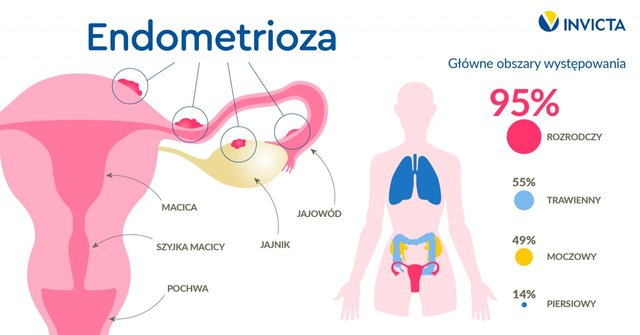 endometrioza-inforgrafika-3.jpg