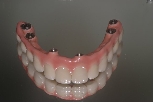 implant bridge.jpg