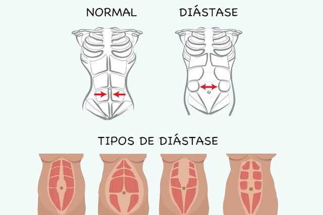 Diastese Abdominal.jpg